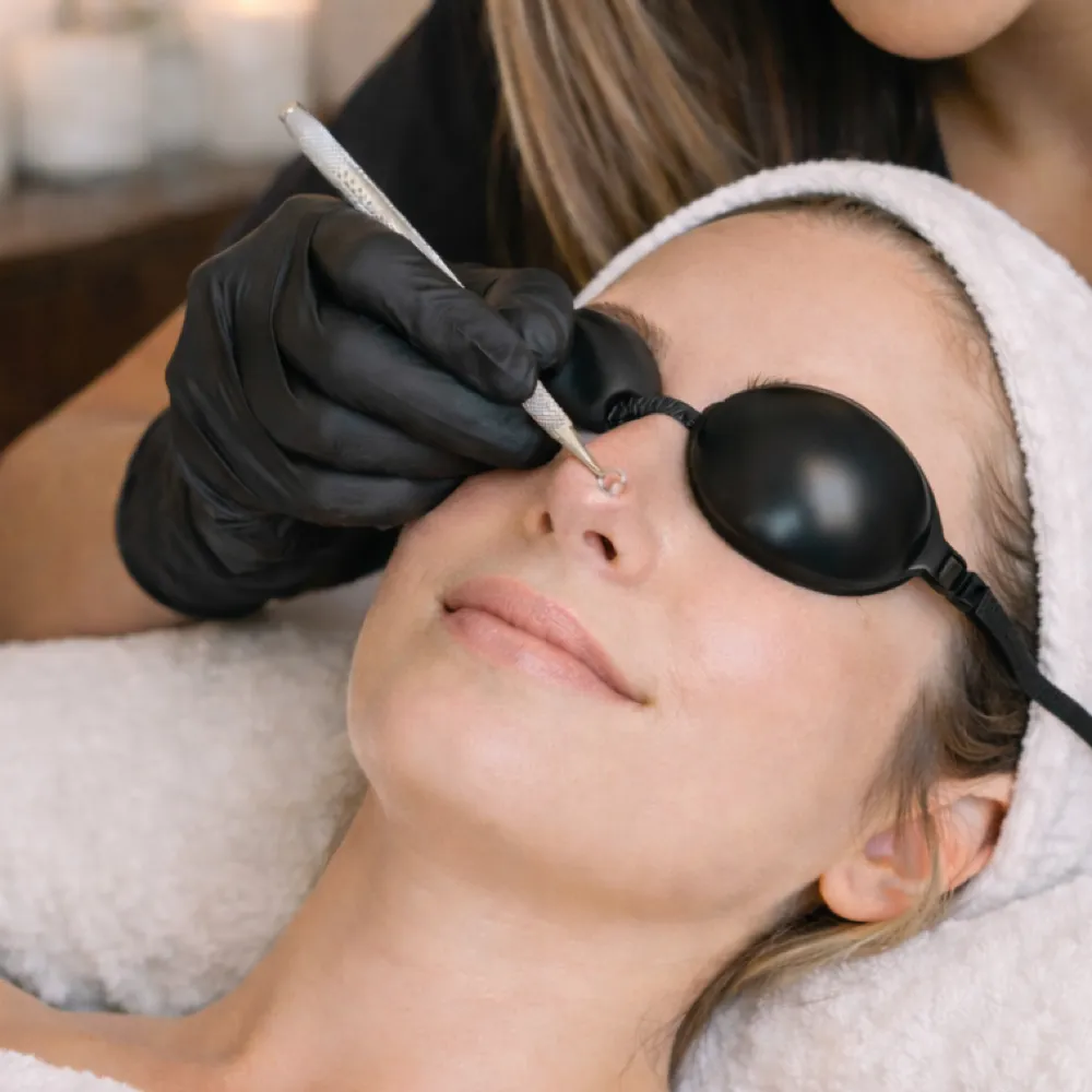Simply Acne Treatment (50 Min) at Simply Facials